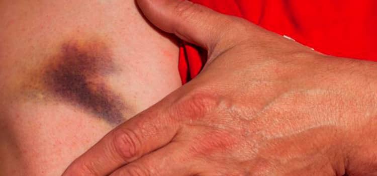 Hematomas en la piel en ancianos. Causas y tratamiento